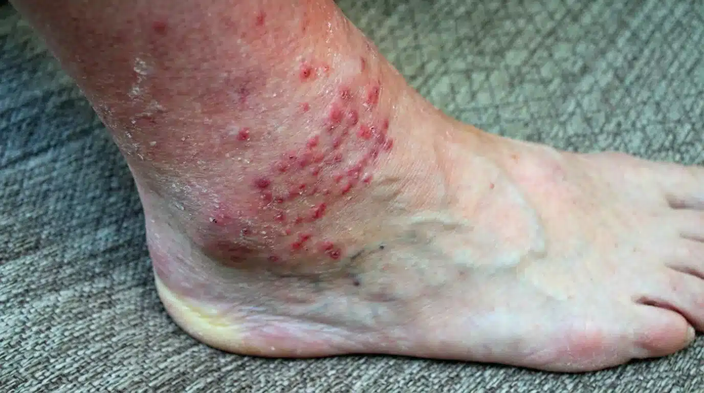 Close-up of a foot and ankle showing clusters of small red, irritated bumps consistent with chigger bites.